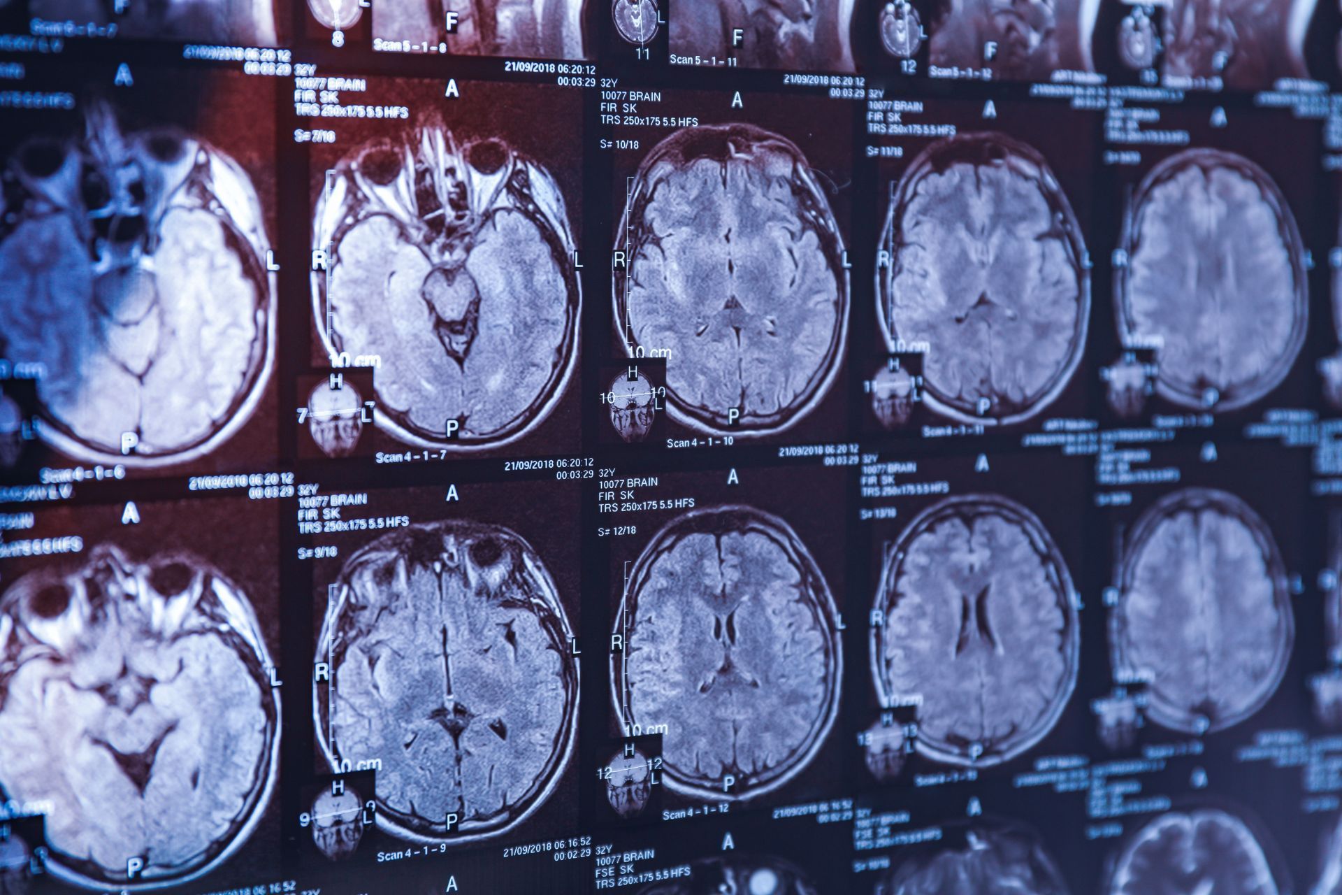 Коензим Q10 и невродегенеративни заболявания - какви са връзките?